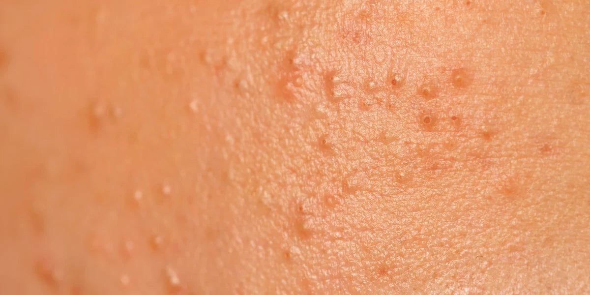 Unreine & Fettige Haut